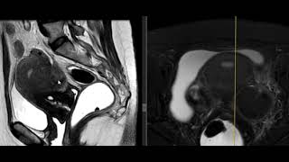 ENDOMETRIOSIS PROFUNDA Y QUISTES ENDOMETRIOSICOS  EVALUACION POR RESONANCIA MAGNETICA [upl. by Buke116]