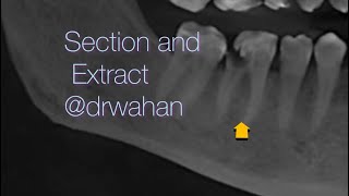 Extract this Brittle Lower Molar [upl. by Ainoloppa]