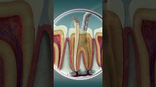 Treatment for Tooth Conditions Conducting Endodontics [upl. by Bullen]