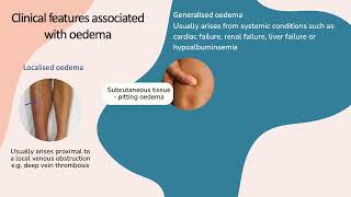 Clinical presentation of oedema [upl. by Tterrej801]