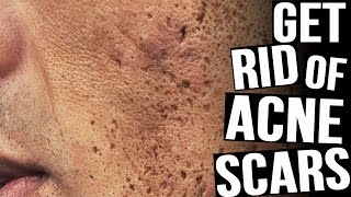 How To Get Rid Of Acne Scars  The BEST Methods [upl. by Anan]