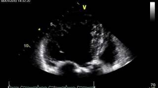 NON COMPACTION CARDIOMYOPATHY [upl. by Nila41]