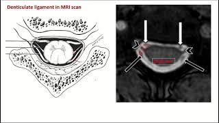 Denticulate ligaments pia mater [upl. by Eelyek]