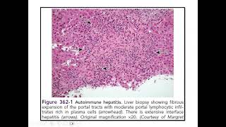 Pediatric Hepatology Cases  Discussion [upl. by Aivekal842]