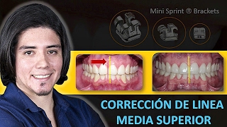 Corrección de línea media [upl. by Season]