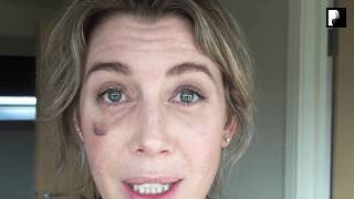 Blepharoplasty Video Diary  3 Weeks After Surgery 13 of 15 [upl. by Luaped]