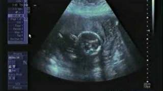 Ultrasound  20 Weeks  Baby Boy [upl. by Neraa389]