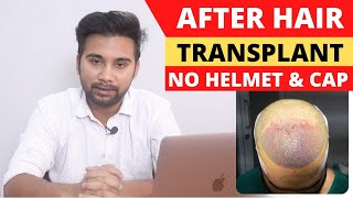 Why Cant We Use Helmets and Cap After Hair Transplant  Precautions After Hair Transplant [upl. by Inalel]