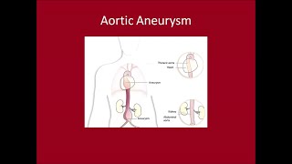 Management of Aortic Aneurysms [upl. by Romilly]