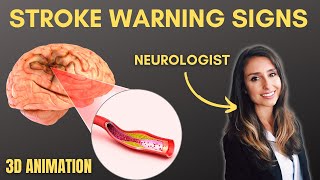 Recognize a Stroke  Neurologist explains [upl. by Wolfe]