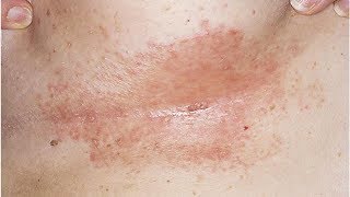 Natural Remedies for Intertrigo Candida of the Skin Folds [upl. by Nana322]