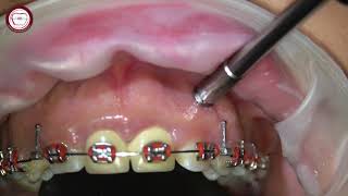 Miniscrew removal in orthodontics [upl. by Annette]