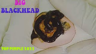 pimple popping 2022 new blackheads amp whiteheads big cystic 2022 best acne [upl. by Anialram953]