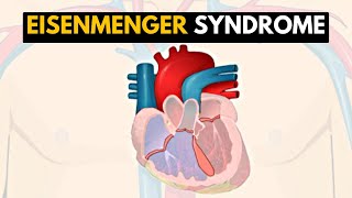 Eisenmenger Syndrome Explained A Comprehensive Guide [upl. by Aicenev473]