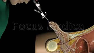 Cystoscopy  Animated Atlas of BPH and OAB [upl. by Nuawad]