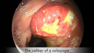 Stenotic colon cancer [upl. by Syxela]