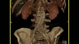 Aortic Stent Graft 3D imaging of a vascular stent in satisfactory position [upl. by Lothaire69]