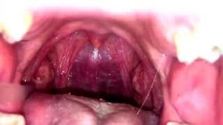 Slow Mo Tonsil Stone Removal [upl. by Avaria]