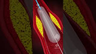 How Does Coronary Angioplasty Work  Blocked Arteries Treatment shorts  creativelearning3d [upl. by Aihn]