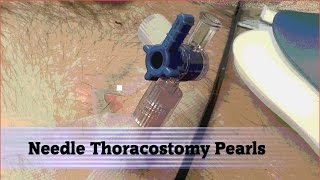 Needle Thoracostomy Pearls [upl. by Drona]