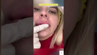 Preenchimento labial com cânula [upl. by Eyot]