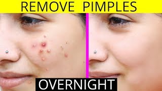 How To Remove Pimples Overnight  Acne Treatment  Anaysa [upl. by Briggs]