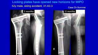 Complex Proximal Femur Fractures [upl. by Suzanna]