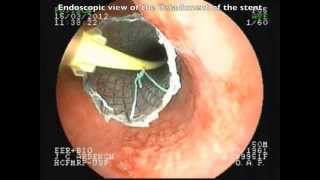 Positioning without fluorscopic esophageal SEMS [upl. by Eednac824]