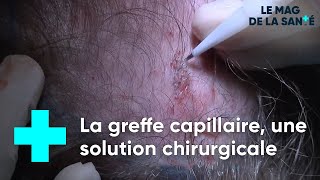 La greffe de cheveux pour éviter la calvitie  Le Magazine de la Santé [upl. by Wexler198]