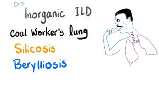 Silicosis Berylliosis amp Coal Workers Pneumoconiosis  Interstitial Pulmonary FibrosisLung Disease [upl. by Quiteris]