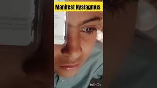 manifest Nystagmus  nystagmus eyediseases [upl. by Avonasac]