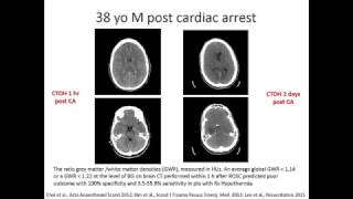 Post Cardiac Arrest Neurological Assessment 02032017 [upl. by Eleonora]