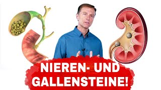 Ursachen von Gallen und Nierensteinen und wie man sie vermeidet  Dr Berg Deutsch [upl. by Karla82]