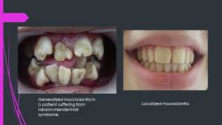 All you need to know about macrodontiaBig teeth by DrAmin [upl. by Aseram694]