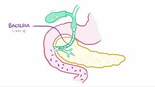 Ascending cholangitis acute cholangitis causes symptoms diagnosis amp pathology [upl. by Singband652]