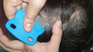 picking dry patchy scabs  scalp scratching  asmr [upl. by Petrine271]