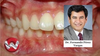 Maloclusiones dentales I [upl. by Airetas]