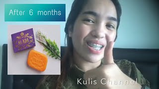 6 Months of Using ALADA SOAP [upl. by Adrianna]