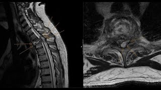 Spinal epidural abscess  spondylodiscitis  insufficiency spinal fracture CT and MRI correlation [upl. by Avrit]