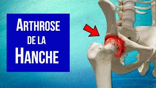 Arthrose de la hanche  Explication et Traitement [upl. by Christensen]