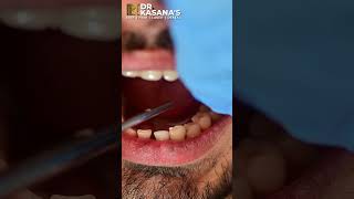 Dentist Filling A Cavity Between Teeth [upl. by Cypro]