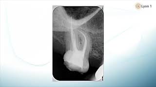 1 Obturation canalaire introduction  Endodontie [upl. by Darrey275]