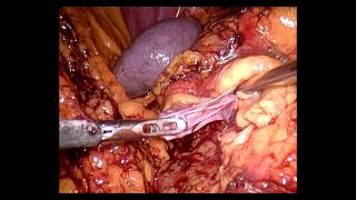 Laparoscopic resection of symptomatic renal cysts [upl. by Grimes]