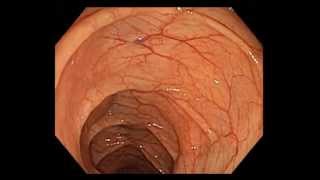 Colonoscopy Channel  Colonoscopy Screening  Excellent quality of colon preparation [upl. by Artinahs]