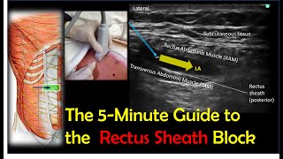 Transversus Abdominal Plane Block [upl. by Borlow539]