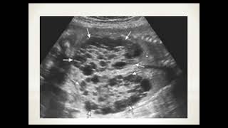 Fetal Dysplastic kidney [upl. by Froma324]