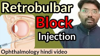 retrobulbar block injection  retrobulbar block  ophthalmologyhindi retrobulbarinjection [upl. by Idyak478]