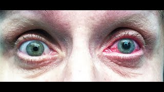 AngleClosure Glaucoma  Symptoms and Causes  Diagnosis  Management and Treatment  Prevention [upl. by Aciria128]