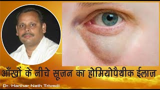 Homeopathic medicine for Puffy Eyes  आँखों के नीचे सूजन का इलाज  Treatment For Swelling under Eyes [upl. by Hussey]