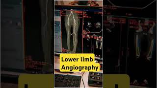 Lower limb angio VRT images vrt angiogram 3d ctangiography ctscan angiography anatomy [upl. by Sukul]